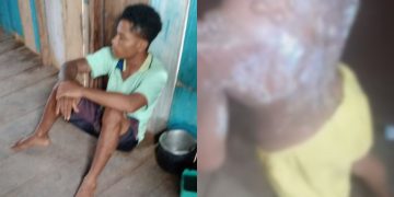 VEJA: Menina de 6 anos fica com as costas queim4das após padrasto jogar mingau quente nela em Autazes