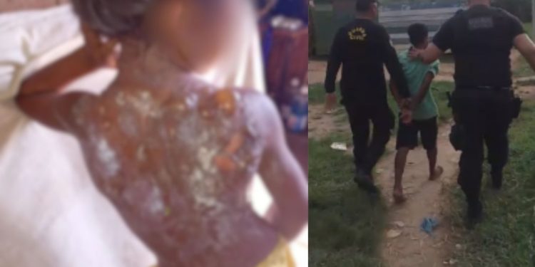 Padrasto que queimou costas da enteada com mingau estava irritado com o choro dela, diz delegado