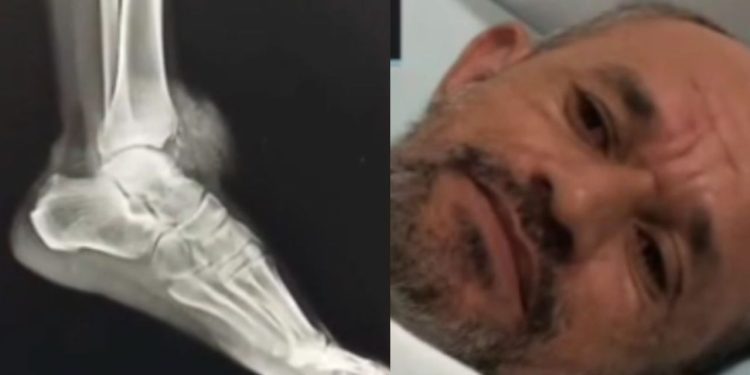 Vídeo: Homem denuncia ter sido b4lead0 no pé por policiais durante operação em Presidente Figueiredo