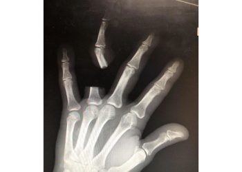 Idoso c0rta o próprio dedo após pic4da de cobra e descobre que ela não era venenosa