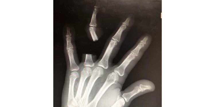 Idoso c0rta o próprio dedo após pic4da de cobra e descobre que ela não era venenosa