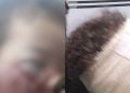 Garotinho de 3 anos é mordido por cachorro e fica com o rosto cheio de pontos em Manaus