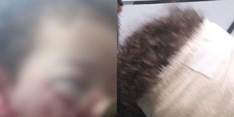 Garotinho de 3 anos é mordido por cachorro e fica com o rosto cheio de pontos em Manaus