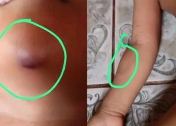 Menina de 3 anos chega em casa com mordidas após passar a tarde em creche indígena no AM
