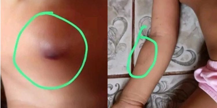 Menina de 3 anos chega em casa com mordidas após passar a tarde em creche indígena no AM