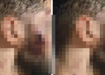 Motorista de aplicativo é perseguido e tem rosto dilacerad0 após colisão no Distrito